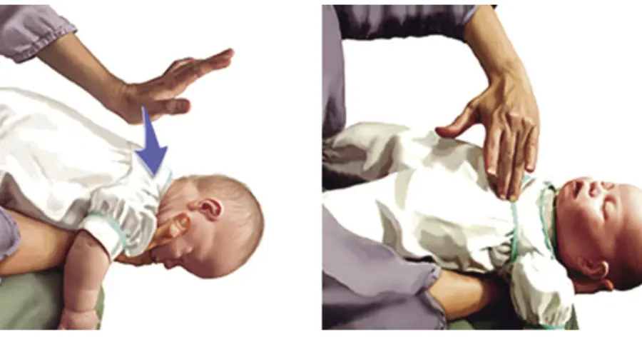 ¿Cómo actuar frente a un atragantamiento durante la alimentación infantil en el menor de 1 año?